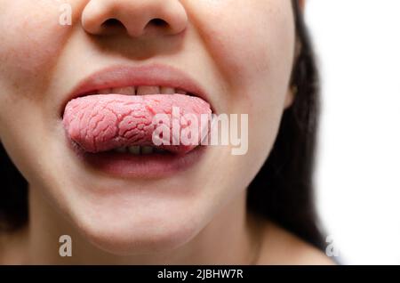 Tongue of a young Caucasian woman with benign migratory glossitis. ongue with candidiasis. Cracks in the tongue. Stock Photo
