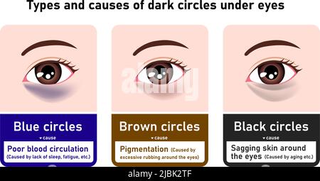 Types And Causes Of Dark Circles Under Eyes. Vector Illustration ...