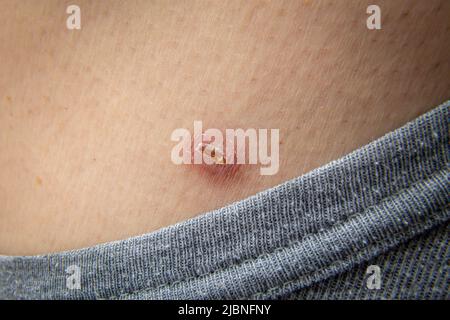 Little scar on the skin on a human body after the medical dermatologist treatment with liquid nitrogen to remove the skin tag or skin mole. Skin mole Stock Photo