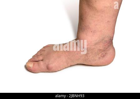 Swelling female leg with inflammation in diabetic nephropathy and varicose veins. Elderly woman's leg with hematoma and edema on white background. Stock Photo