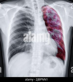 Chest xray fusion with Lung 3D rendering image for diagnosis TB ...