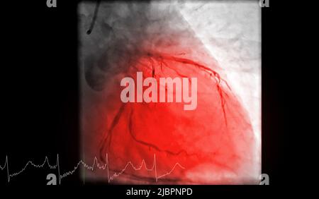 Cardiac catheterization is a test used to find out  cardiac arrest . Stock Photo