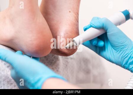 A podologist does a hardware peeling of dirty dry skin of the heels. Close-up of the feet and master's hands. The concept of professional pedicure and Stock Photo