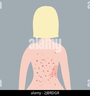 Caucasian short blonde hair woman with acne on her back. Skin problems concept.  Stock Vector