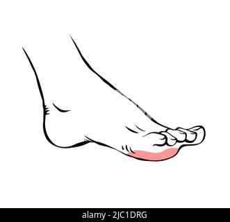 A woman leg with a sore callus. Transverse flat feet. Orthopedic ...