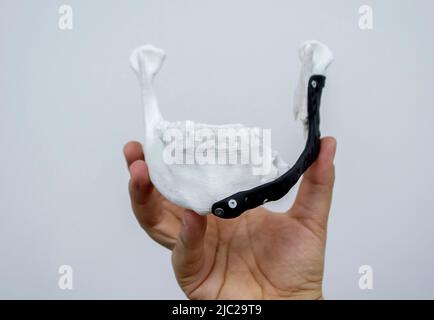 Man holding implantation of endoprosthesis of lower jaw. Model of lower jaw printed on 3D printer white plastic. Endoprosthesis printed on 3D printer for metal biocompatible titanium alloy black color Stock Photo