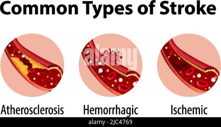 Infographic of common types of stroke illustration Stock Vector