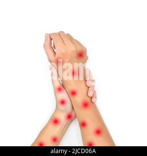 Monkeypox skin rashes over both arms of Asian young man. Isolated on white. Stock Photo