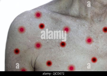 Monkeypox skin rashes over the trunk of Asian old man. Isolated on white. Stock Photo
