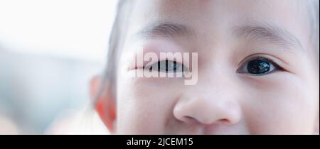 Stye Eye diseases. Closed Asian kid little girl eye with sty, eyelid abscess ophthalmic hordeolum Stock Photo