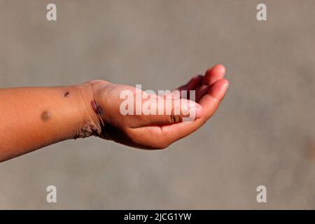 Child hand with monkey pox Stock Photo