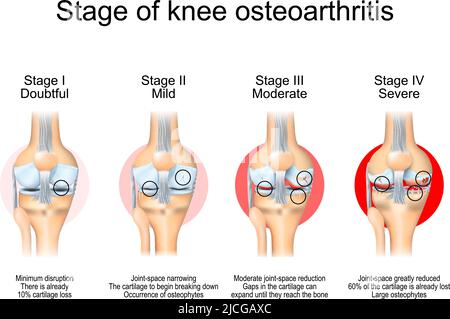 Stages of knee osteoarthritis. From Minimum disruption to lost a cartilage and joint-space reduction. Anatomy of knee joint. Vector illustration Stock Vector