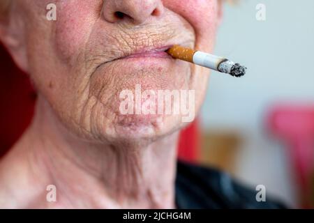 cigarette wrinkles The Myth of Smoker's Lines Tobacco Addiction | Basicmedical Key