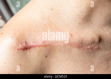 Suture wound after fracture of the right clavicle, one month after surgery Stock Photo