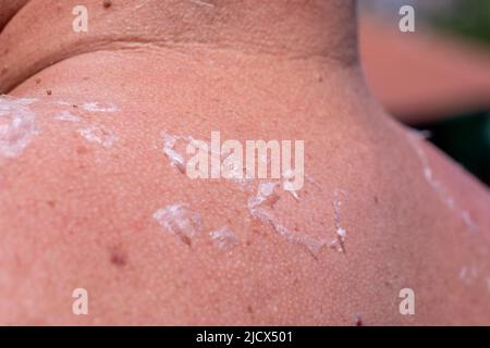 Sunburn. Closeup of Peeling sunburned skin on back and shoulder stock photo Stock Photo