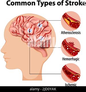 Human with common types of stroke illustration Stock Vector