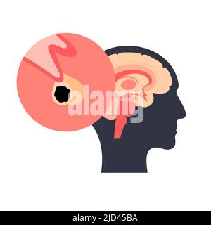 Pituitary adenoma cancer, illustration Stock Photo