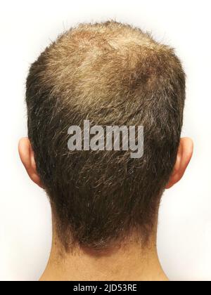 Rear view of a male head without hair on scalp isolated on white background. Hair loss concept, bird's nest on the head. Problems with hair regrowth, Stock Photo