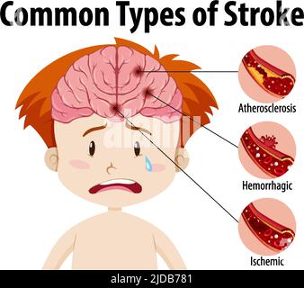 Human with common types of stroke illustration Stock Vector