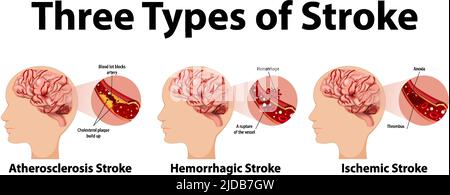 Infographic of common types of stroke illustration Stock Vector