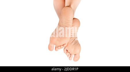 Dry and cracked soles of feet on white background. Dry Female heels. woman with rough and dry skin on heels of her feet. Dry and cracked soles of feet Stock Photo