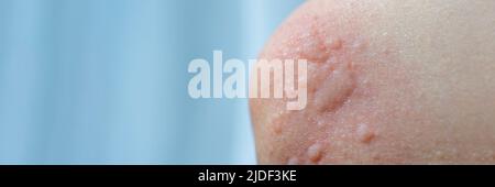 Urticaria on the skin. Red spots of an allergic reaction on the skin of a child. Urticaria symptoms close up Stock Photo