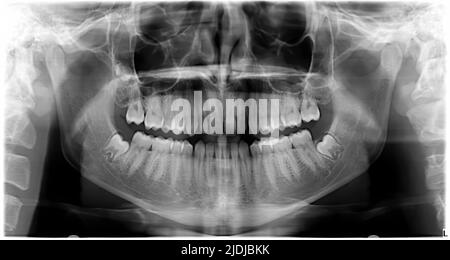 Pantography of the perfect teeth of a healthy young man. X-ray of a human mouth Stock Photo