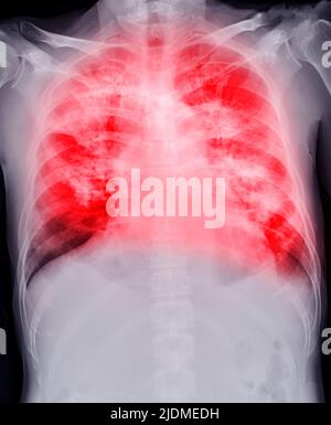 Chest xray image showign TB,tuberculosis or covid-19 Stock Photo - Alamy