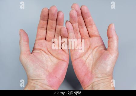 Bilateral palmar erythema (PE). Red hands palm. Stock Photo