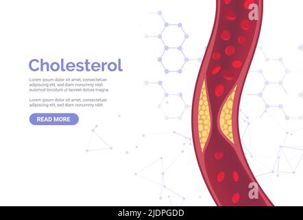 Cholesterol artery thrombosis micro vascular desease. Arteriosclerosis blood vector atherosclerosis risk Stock Vector