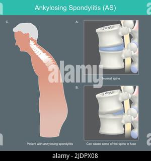 Ankylosing spondylitis. Human spine deformities from inflammation and can cause some of the spine to fuse. Stock Vector
