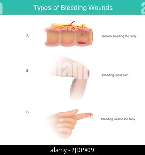 injured and bleeding fingers vector illustration design Stock Vector ...