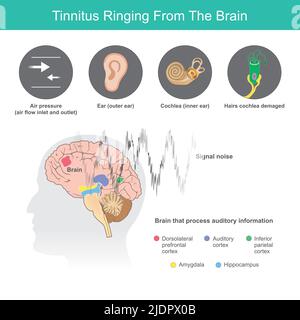Tinnitus Ringing From The Brain, Is the term for a buzzing noise in your ears from symptoms abnormal in ears or the brain. Stock Vector