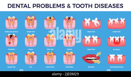Dental problems educational infographic info chart set with  caries pulpit inflammation tooth plaque enamel erosion vector illustration Stock Vector