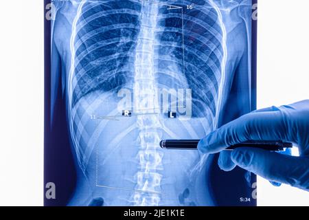 Doctor analyzing X ray of the spine showing scoliosis in the lumbar area. Scoliosis is an abnormal lateral curvature of the spine. Stock Photo