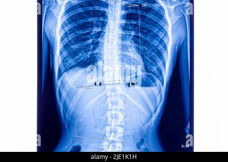 X ray showing scoliosis of the lumbar spine. Scoliosis is an abnormal lateral curvature of the spine. Zoom in. Stock Photo