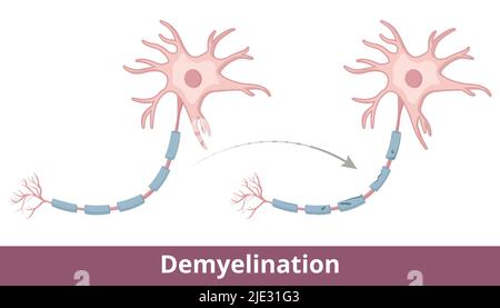 Multiple Sclerosis Process Multiple sclerosis. demyelinating disease. autoimmune disease. Vector ...