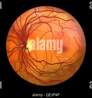 Normal retina, ophthalmoscope image, illustration. The retina is the light-sensitive membrane that lines the back of the eye. Blood vessels (red) radiate out from the optic disc (yellow, left). The optic disc is the area where the optic nerve and blood vessels enter the eye. Due to this, it has no light-sensitive cells, and is the cause of the blind spot. The dark red area at right centre is the macula. This is the region of the retina with the highest concentration of light-sensitive cells, and is responsible for the sharp vision at the centre of the visual field. Stock Photo