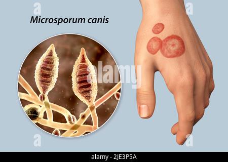Fungal infection on a man's hand, illustration. Known as ringworm infection, or tinea manuum. It can be caused by various fungi, including Microsporum canis. It causes severe itching. The disease is highly contagious, and can be spread by direct contact or by contact with contaminated material. Treatment is with antifungal drugs. Stock Photo