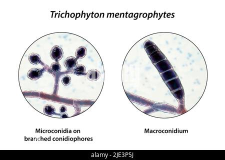 Fungi Trichophyton mentagrophytes, the cause of athlete's foot (tinea ...