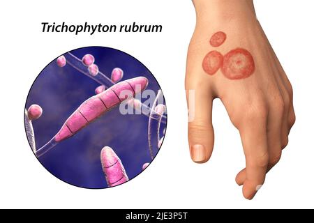 Fungal infection on a man's hand, illustration. Known as ringworm infection, or tinea manuum. It can be caused by various fungi, including Trichophyton rubrum. It causes severe itching. The disease is highly contagious, and can be spread by direct contact or by contact with contaminated material. Treatment is with antifungal drugs. Stock Photo