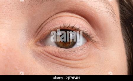 female eye closeup, keratoconus disease of the cornea. Stock Photo