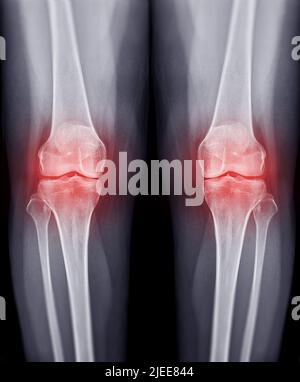 Film X Ray Both Knee Joint Ap View For Diagnosis Knee Pain From