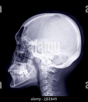 Skull x-ray image of Human lateral view  isolated on Black Background. Stock Photo