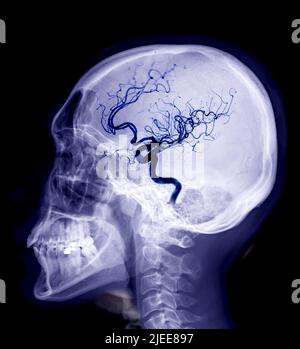 Skull x-ray image of Human lateral view with cerebral angiogram   isolated on Black Background. Stock Photo