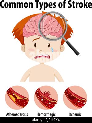 Human with common types of stroke illustration Stock Vector