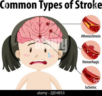 Human with common types of stroke illustration Stock Vector