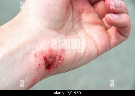 Red wound on the palm, arm, wrist after a burn or fall. First aid in wound treatment. Treatment of wounds. Extreme close up of a red skin burn Stock Photo