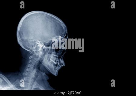 x ray human skull on black background lateral view Stock Photo