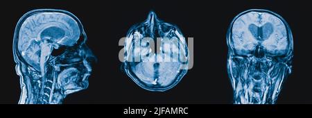 Human brain on MRI scans Frontal, sagittal and transverse sectional planes of the human head on MRI scans Stock Photo
